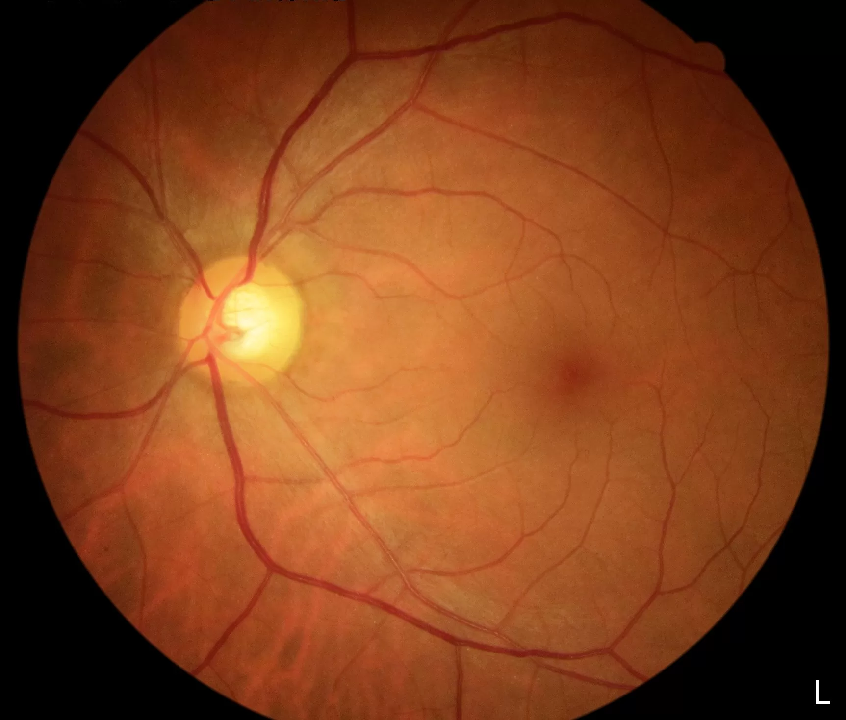 Glaucoma — prevenção