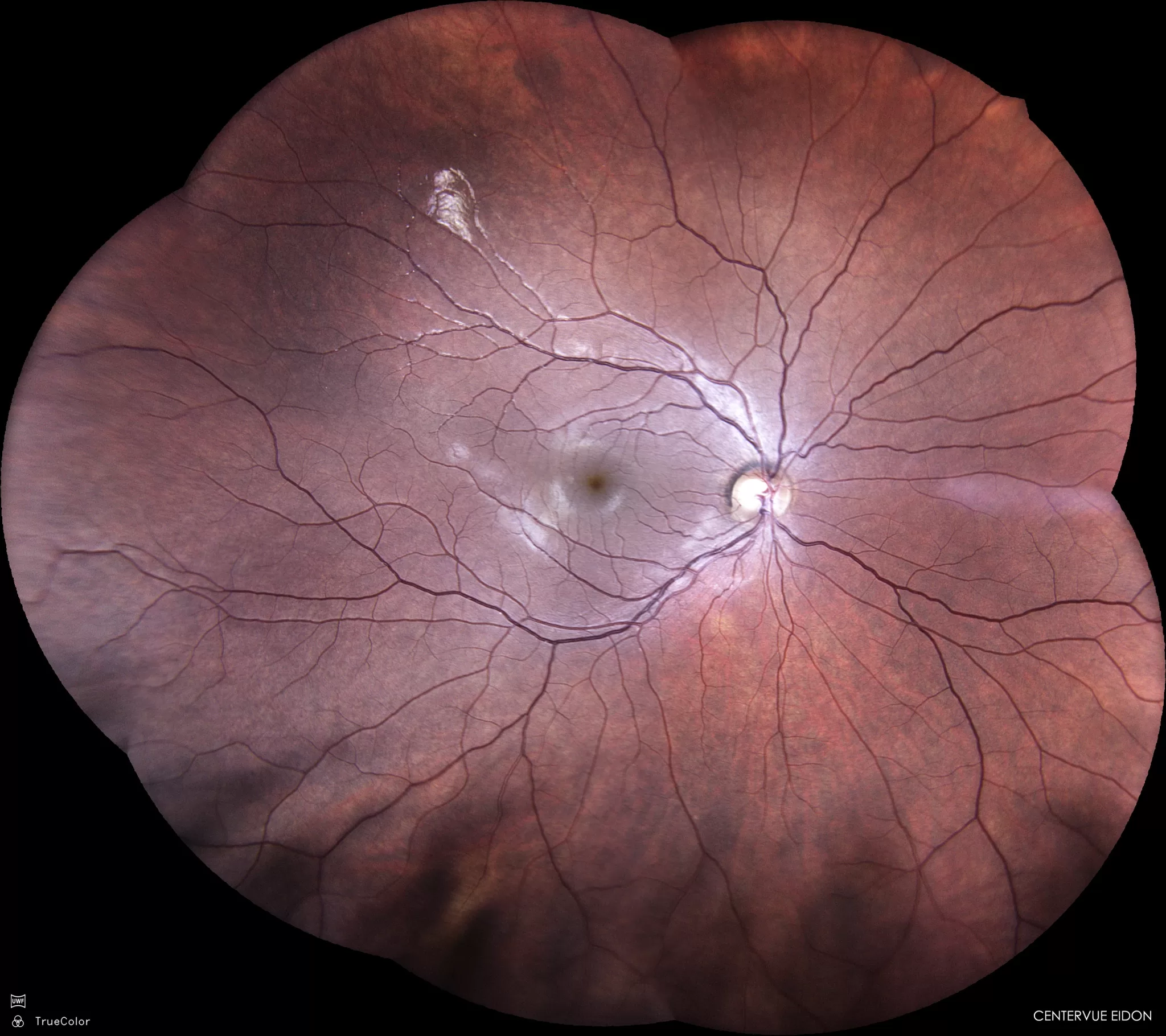 Figura 1 Retinografia da retina