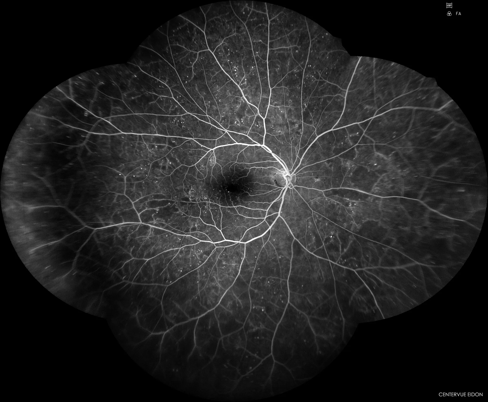Figura 10 Angiografia Fluoresceinica de campo ultra amplo